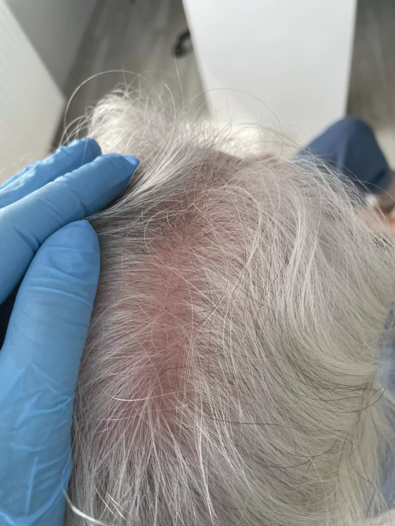 Konsultacja Trychologiczna Trycholog Bydgoszcz – Milena Kwaśniewska, specjalizuję się w diagnostyce i leczeniu problemów skóry głowy oraz włosów, oferując profesjonalne konsultacje i indywidualnie dobrane terapie. Nowa 15, 85-119 Bydgoszcz https://milena-trycholog.pl