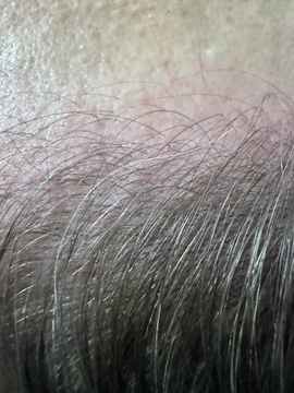 Łysienie bliznowaciejące czołowe FFA Trycholog Bydgoszcz – Milena Kwaśniewska, Specjalizuję się w diagnostyce i leczeniu problemów skóry głowy oraz włosów, oferując w gabinecie „Trycholog Bydgoszcz Milena” przy ul. Nowej 15 profesjonalne konsultacje oraz indywidualnie dobrane terapie, aby Twoje włosy były zdrowe i piękne. https://milena-trycholog.pl Najlepszy Trycholog w Bydgoszczy